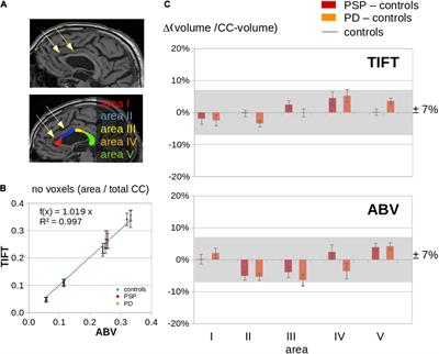 Segmental Alterations of the Corpus Callosum in Progressive Supranuclear Palsy: A Multiparametric Magnetic Resonance Imaging Study